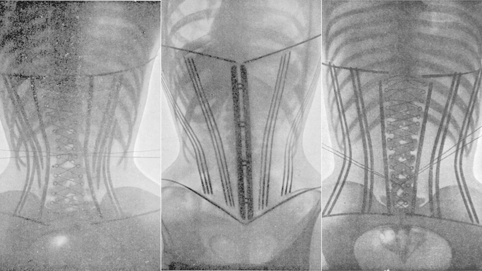 Corsets And Health Should You Be Worried By Corseted X Rays