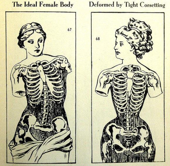 Corsets and Health Should You Be Worried by Corseted XRays?