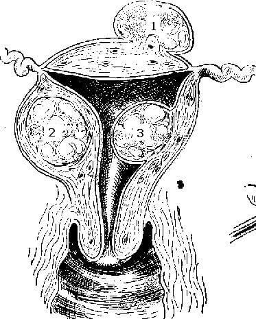 Medical illustration of fibroids